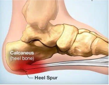 Heel Spurs Symptoms And Options For Treatment OrthoMed Canada